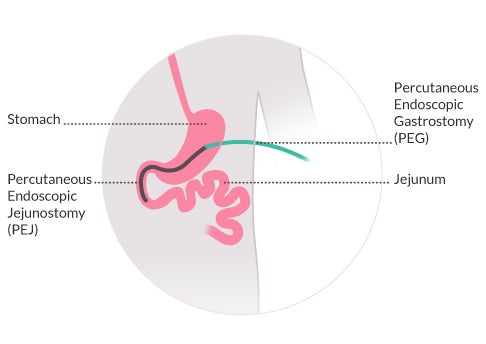 tube feeding