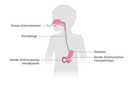 tube feeding cerebral palsy